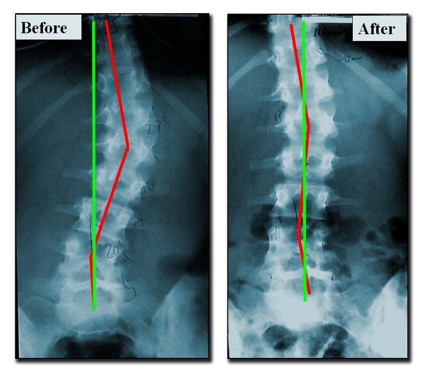 Scoliosis Before & After 01