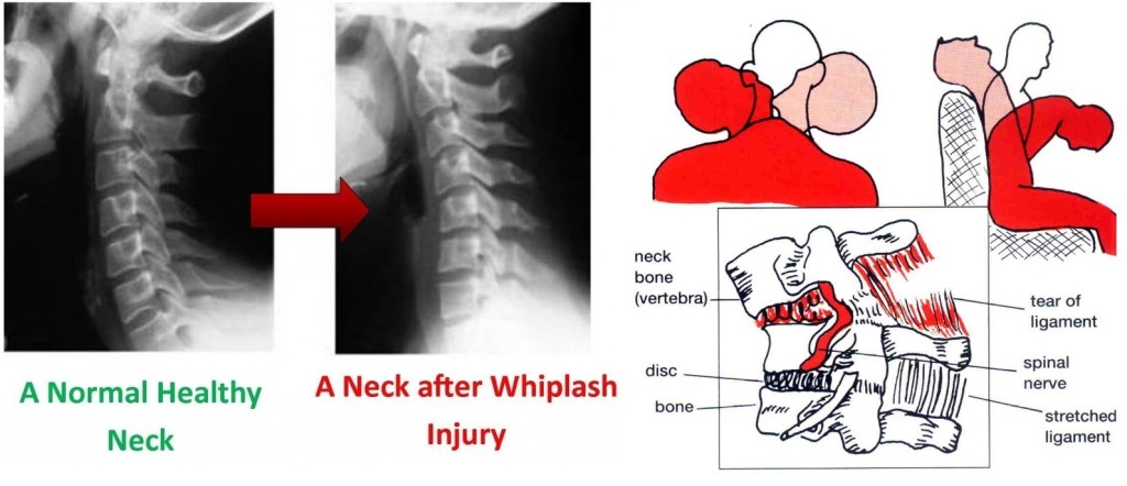 Structural Effect of Whiplash 03